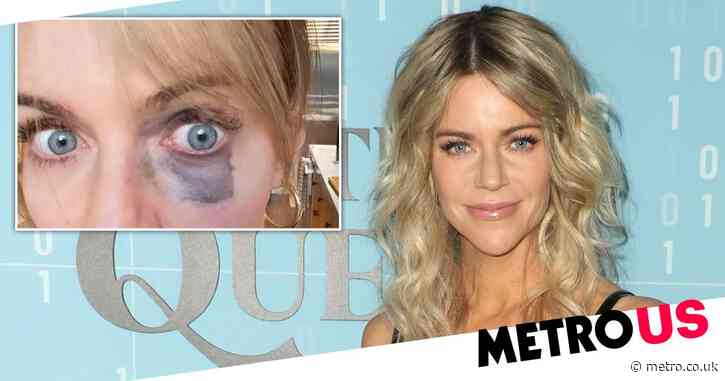 It’s Always Sunny in Philadelphia star Kaitlin Olson reveals nasty shiner after filming blunder