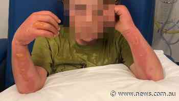 Boy suffers burns from common fruit