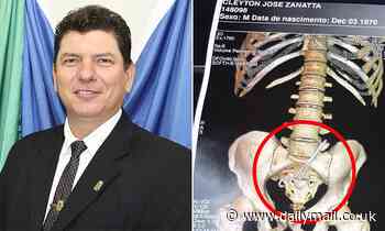Brazilian councilman has scissors removed from abdomen after surgeon forgot them inside