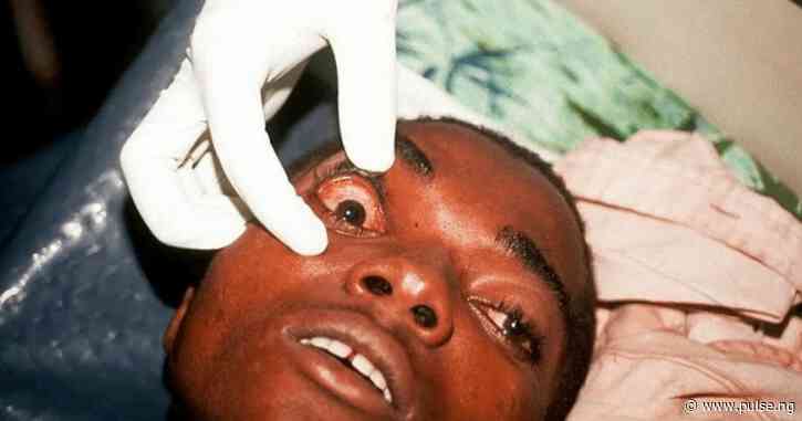 Tanzania confirms outbreak of deadly Marburg virus
