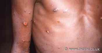 CDC issues urgent mpox warning as summer parties threaten 'resurgence' of viral disease