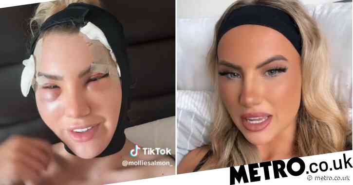 Love Island’s Mollie Salmon reveals results of fox eye surgery after alarming fans with post-procedure swelling