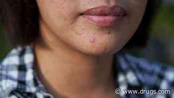 Spironolactone Found to Improve Acne in Adult Women