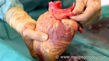 Trial Affirms Safety of Circulatory-Death Heart Transplants