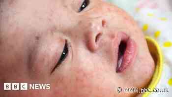Cardiff measles outbreak prompts MMR vaccination plea
