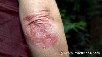 Biologic Treatment for Psoriasis Linked to Lower Mortality