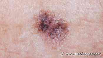 What’s The Incidence Rate of a Second Primary Melanoma?