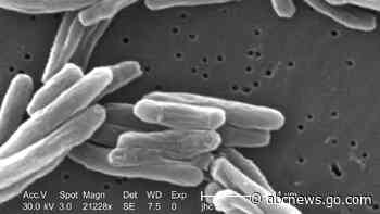US tuberculosis cases were at the highest level in a decade in 2023