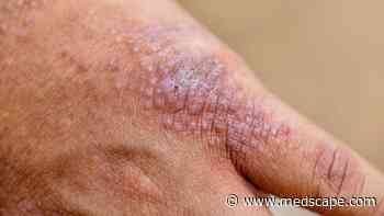 Extension Data Reported for Chronic Hand Eczema Treatment