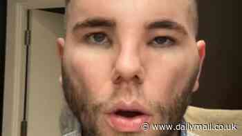 BBC Radio 1 star looks unrecognisable with a swollen and bruised face after admitting a hair transplant left him 'looking like Avatar'