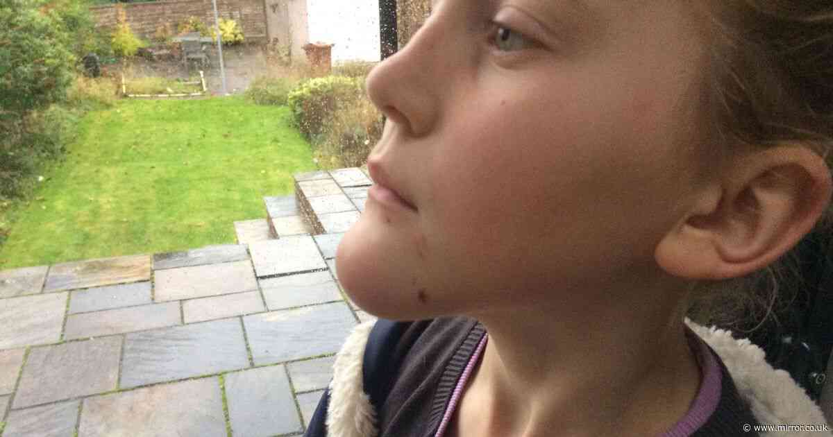 Girl grows 'witch-like' chin from tooth abscess as dentist made to pay family £5,000 compensation