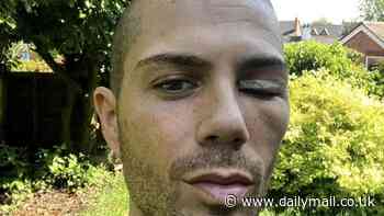 Max George leaves fans concerned after revealing painful bruised and swollen eye