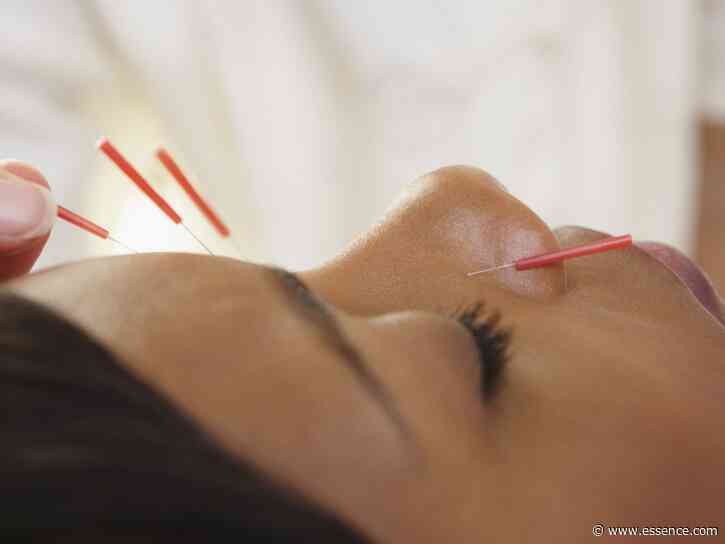 Everything You Need To Know About Facial Acupuncture