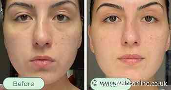 Beauty fans swap expensive skin creams for £16 anti-aging Amazon tool that tightens skin