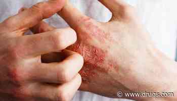 Atopic Dermatitis Negatively Impacts Mental Health