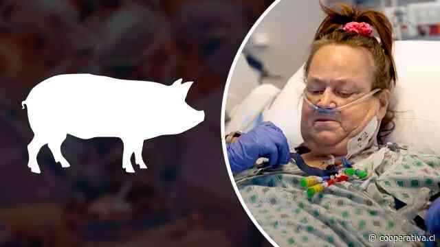 Mujer de 54 años recibió trasplante de bomba cardíaca y riñón de cerdo