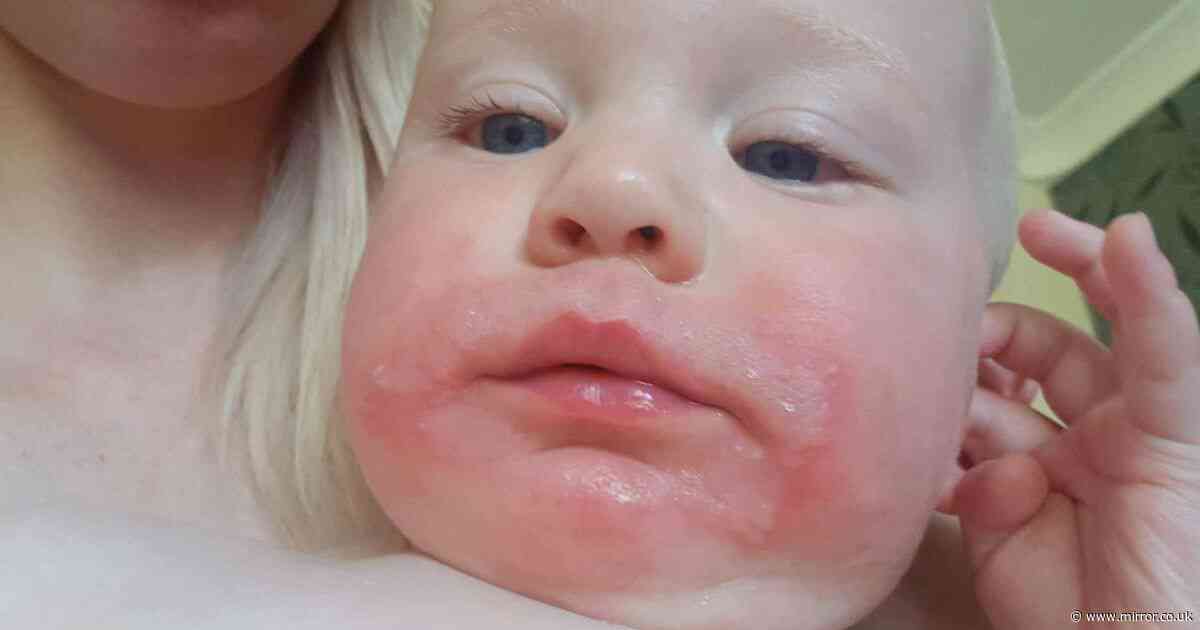 Screaming toddler has skin removed after brush with 'UK's most dangerous plant'