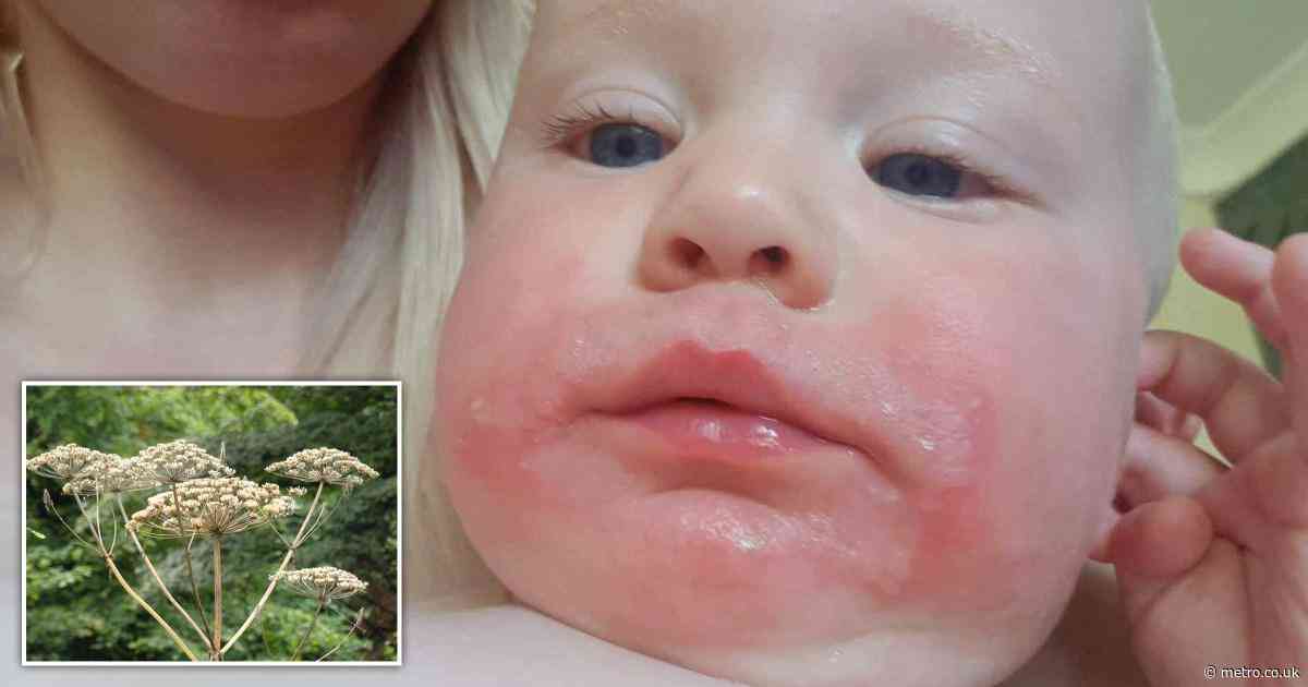 Boy, 2, left with painful blisters after touching Britain’s most dangerous plant