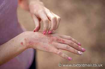 What is dermatitis? Symptoms, treatment and when to see a GP
