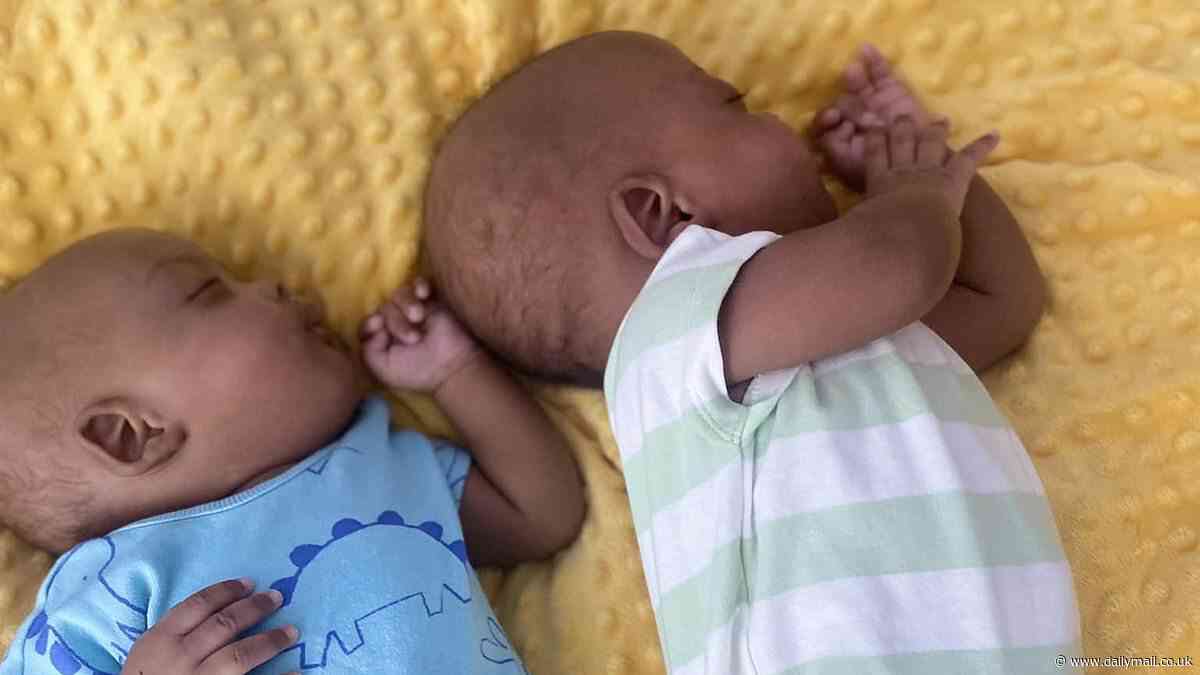 Conjoined twin brothers celebrate their first birthday together one year after they were separated in a six hour operation