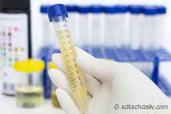 Prostate Cancer Breakthrough: Urine Test Avoids Unnecessary Biopsies