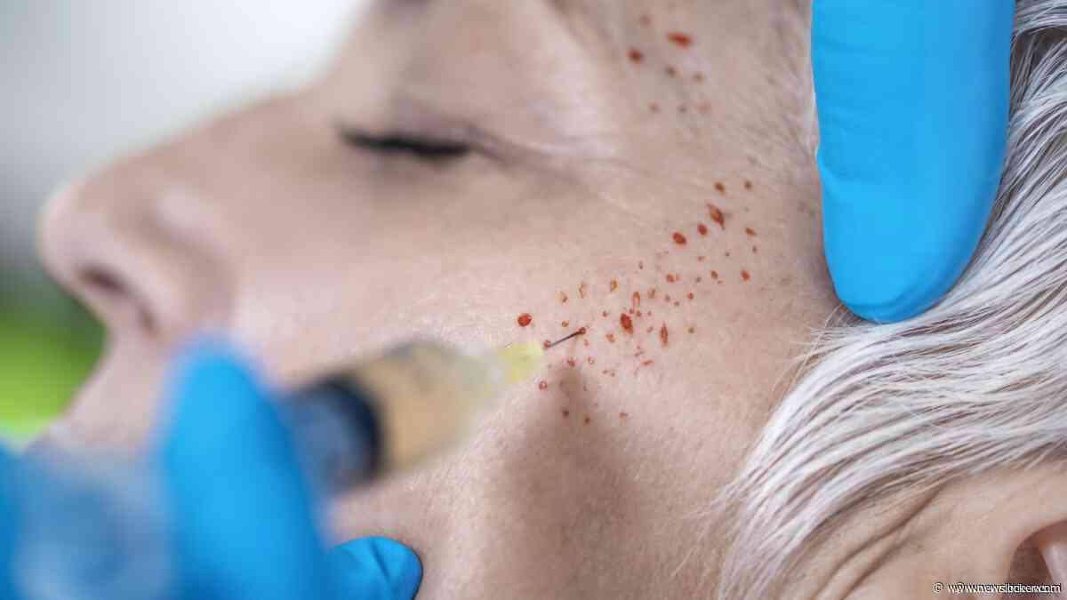 Drie vrouwen in VS kregen hiv door besmette naalden bij 'vampire facial'