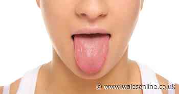 What it means if your tongue turns green, blue, orange, black or grey
