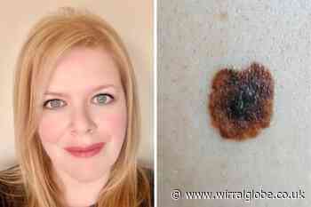Wirral woman’s warning after finding ‘brown splodge’ on back