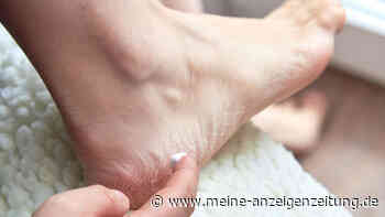 Fußpilz behandeln und Folgeerkrankungen vermeiden