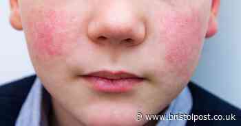 NHS warns of signs your child's red face is caused by common infection