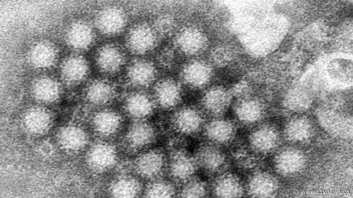 How can I tell if I have norovirus? Expert explains symptoms