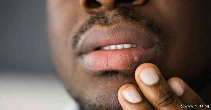 10 things you didn't know about herpes but should