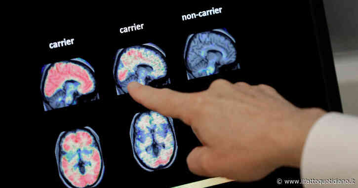 Alzheimer, lo studio su Science: “Grazie a nanoparticelle magnetiche bloccato il deficit di memoria”