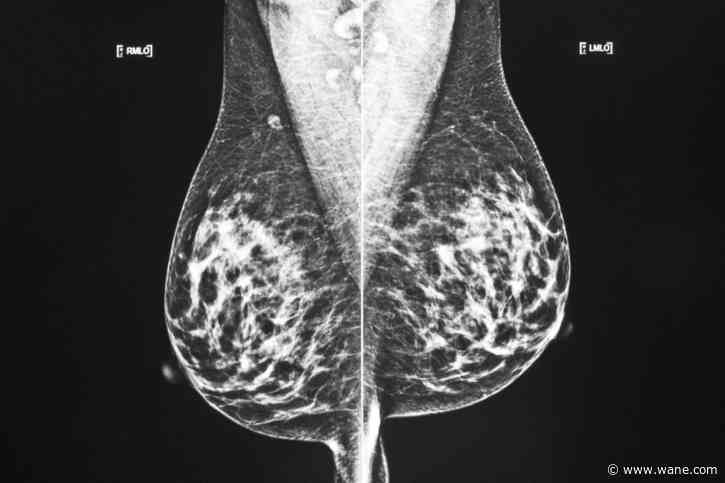 Experts recommend starting breast cancer screenings at 40