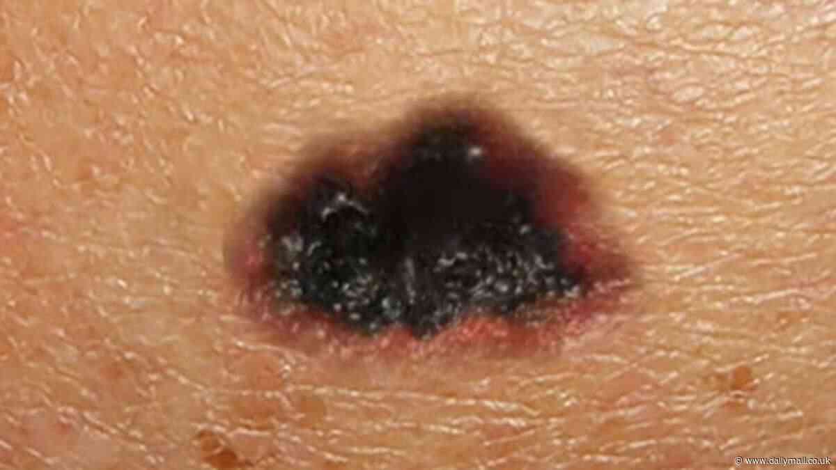 Terrifying time-lapse video reveals how a tiny dark blotch can morph into stage 4 skin cancer
