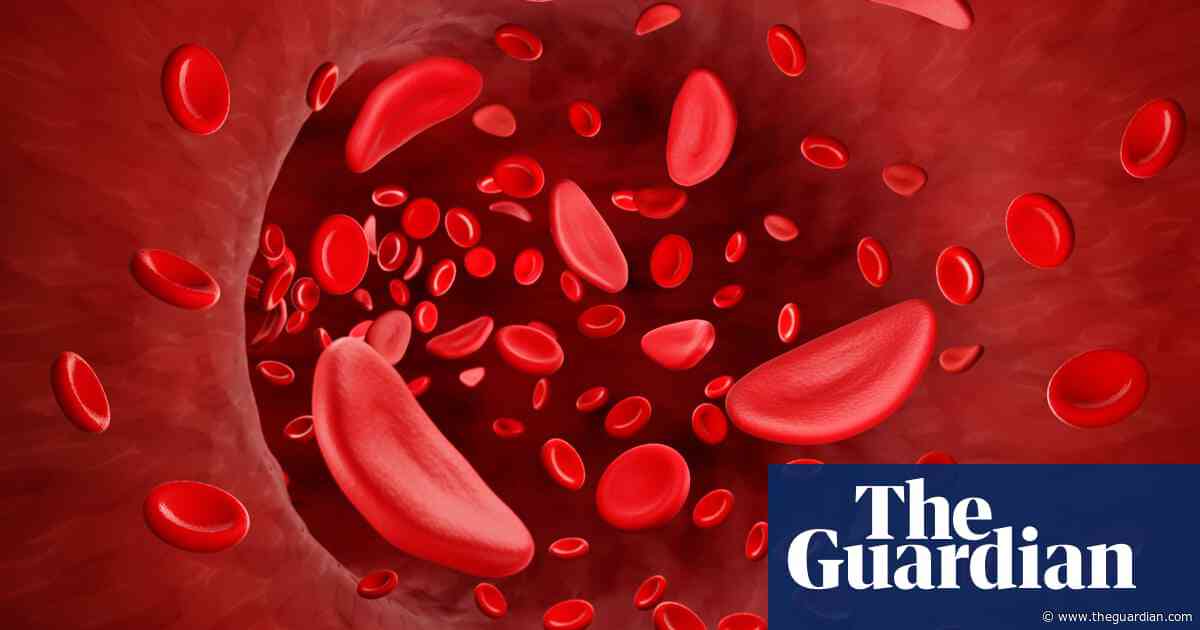 ‘Life-changing’ drug for sickle cell disease to be offered by NHS in England
