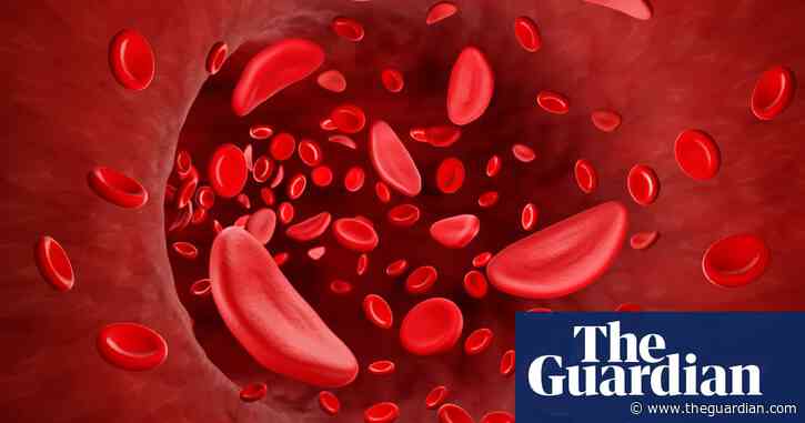 ‘Life-changing’ drug for sickle cell disease to be offered by NHS in England