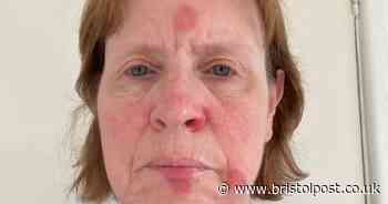 Woman left with red blotches on face after opening air freshener