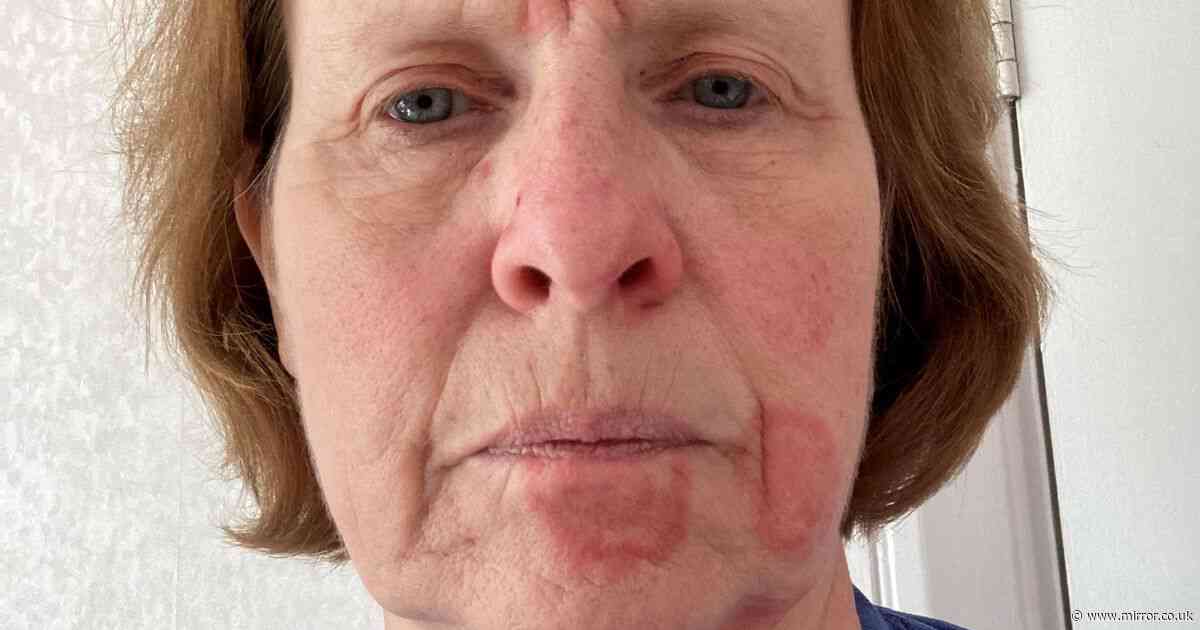 Woman's face left covered in red blotches after air freshener splashes onto her lip