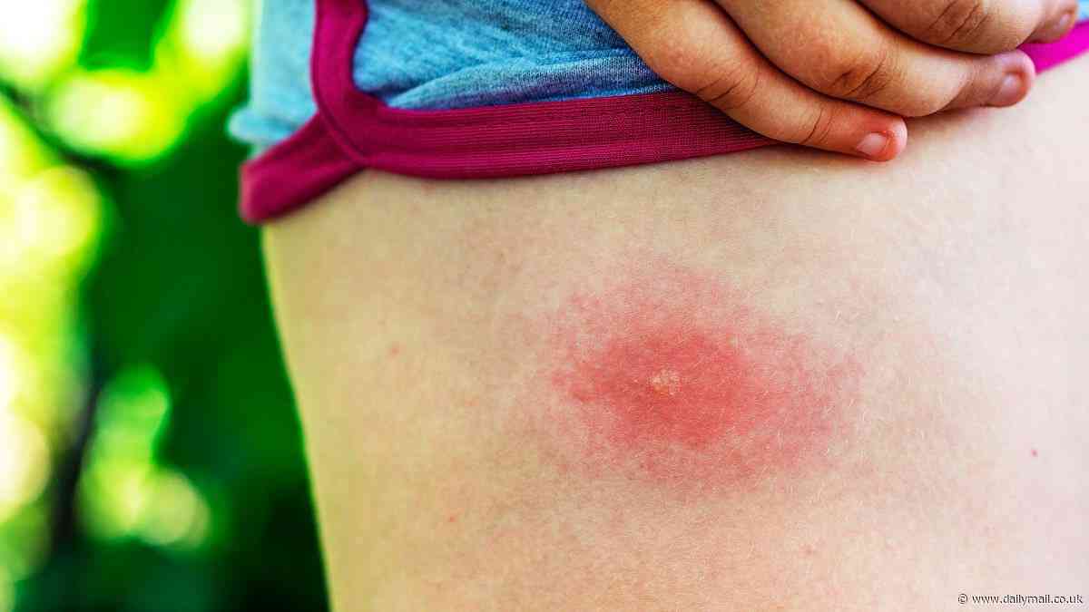 Could YOU tell the difference? Pharmacist warns over eight tell-tale skin marks from a harmless midge bite to a dangerous spider wound