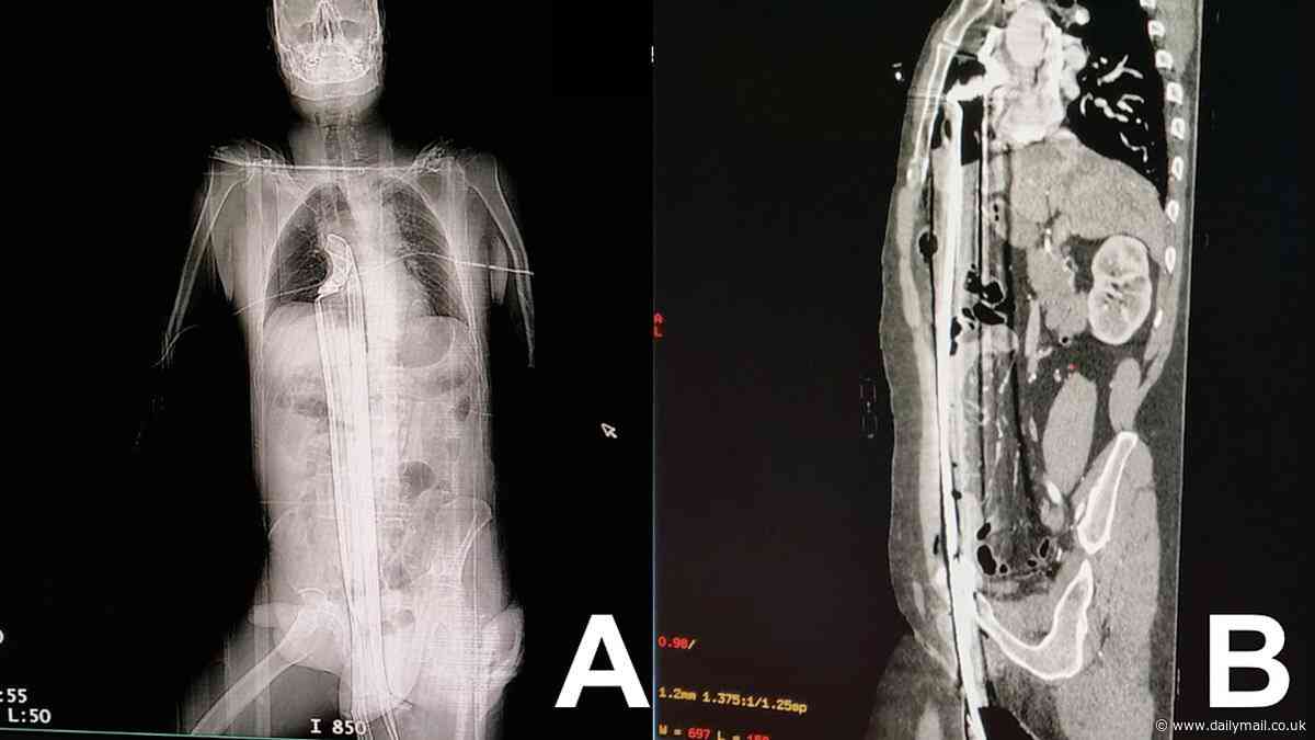 Man narrowly escapes death after 3ft iron rod penetrated through his perineum and into his chest following fall