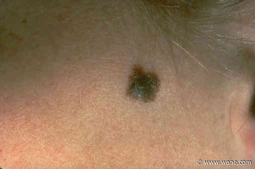 It's Melanoma Monday. Here's why you should care