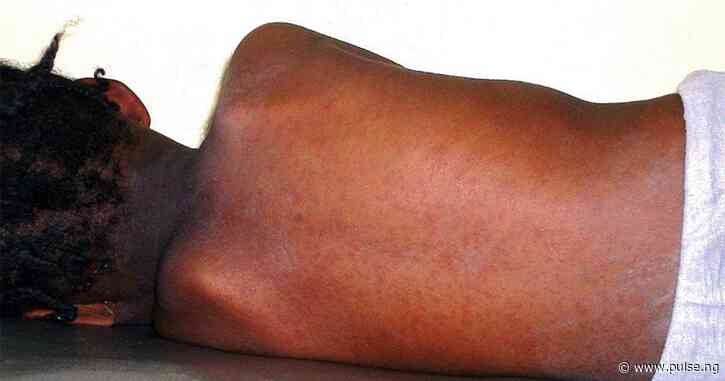 Measles kills 42 children in Adamawa, Govt extends resumption date to May 13