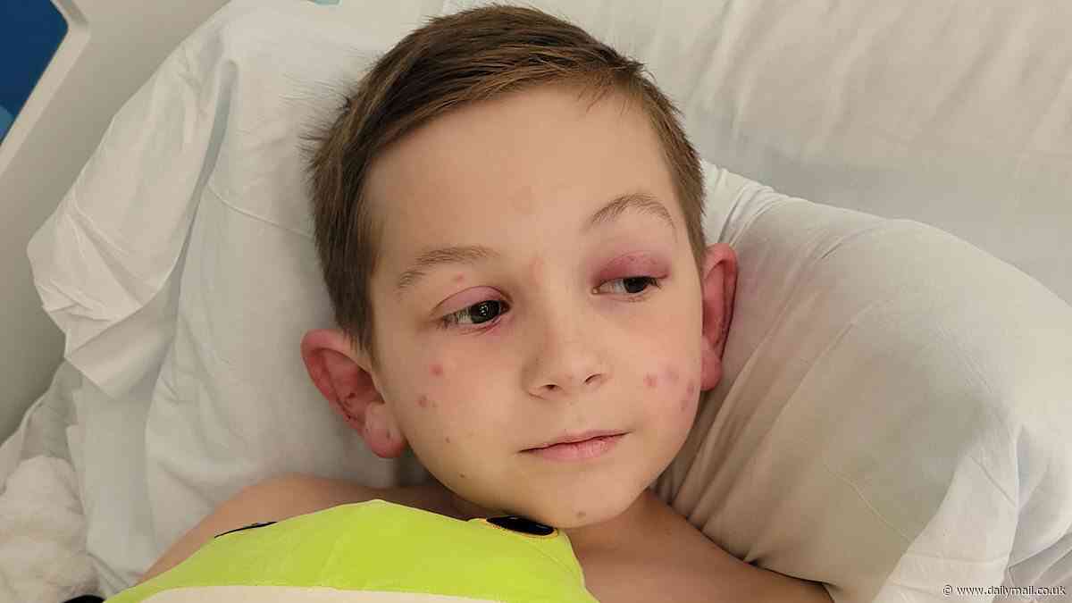 Boy, 10, mysteriously started vomiting during baseball... then finds out he's got ultra rare blood vessel disorder leaving him with blotches all over his body