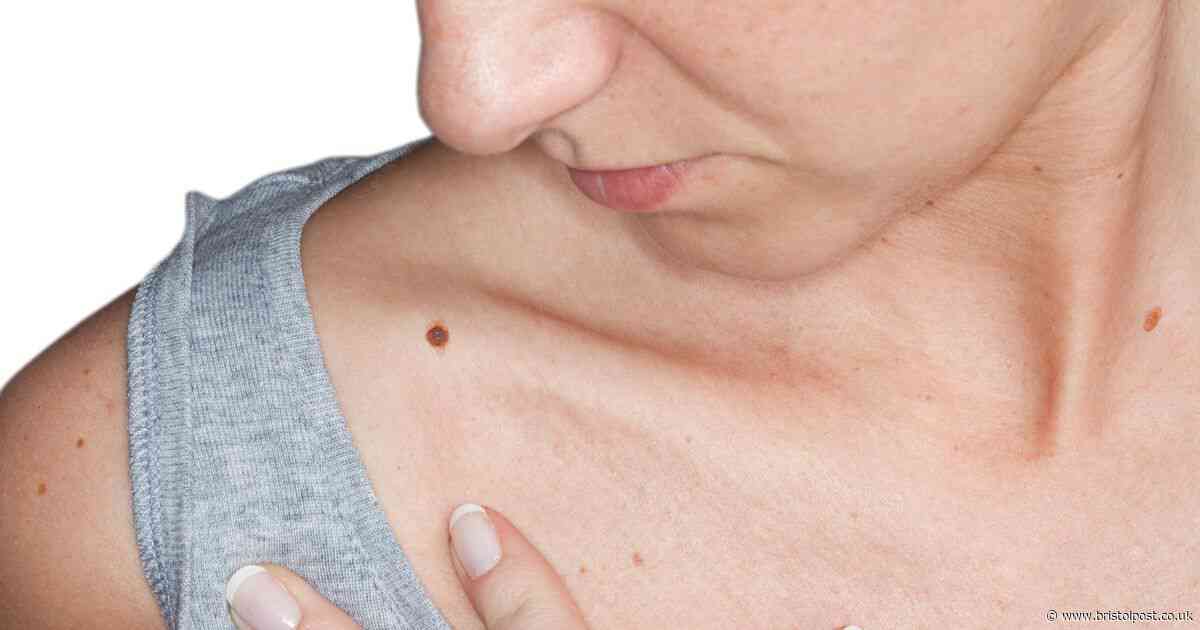 Doctor says five simple letters could tell if you have skin cancer