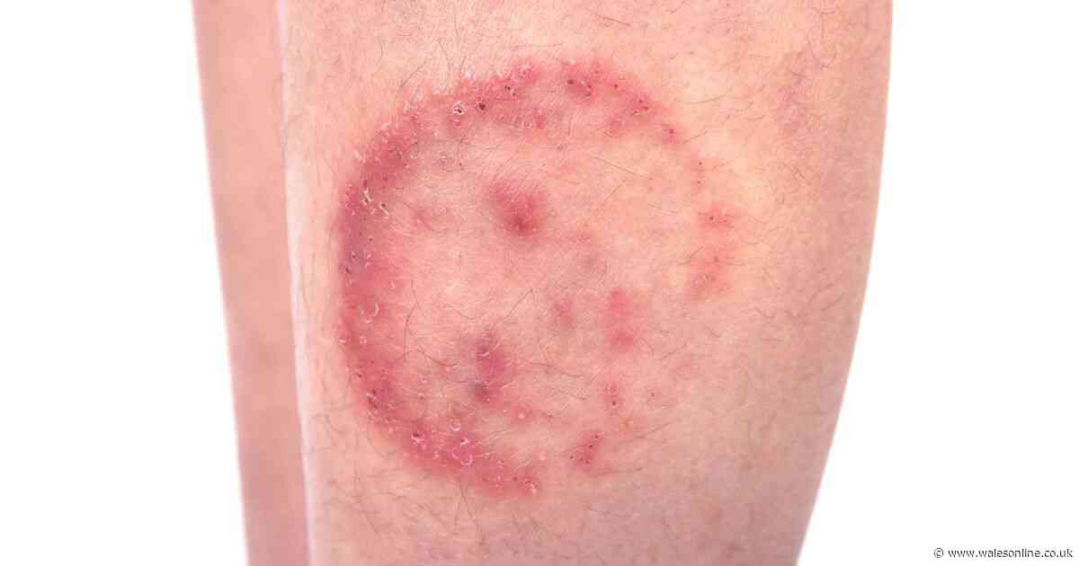 Warning signs of ringworm as social media influencer shares symptom on his face