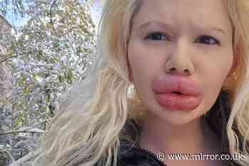 Woman with 'world's biggest lips' gets even more filler in her face to 'even things out'