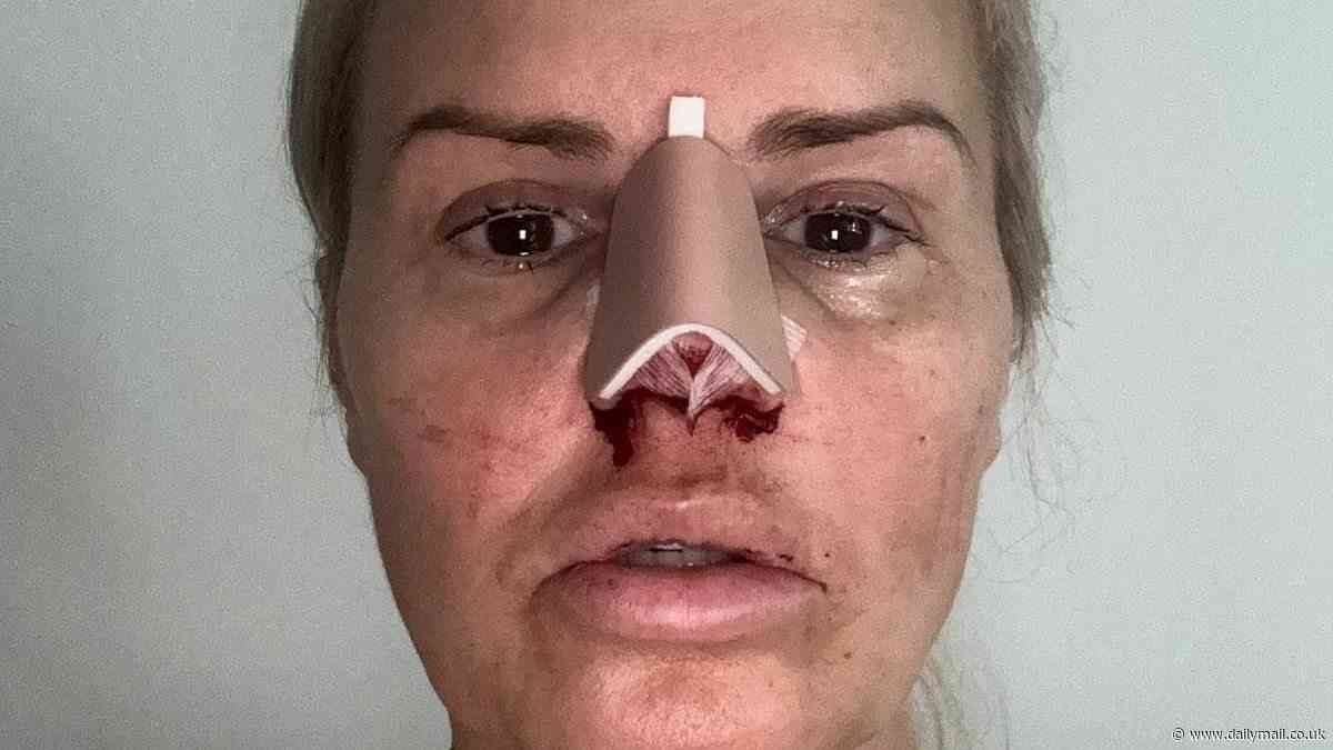 Kerry Katona reveals the gruesome results of her nose job after going under the knife due to past cocaine abuse leaving her with a hole in her septum