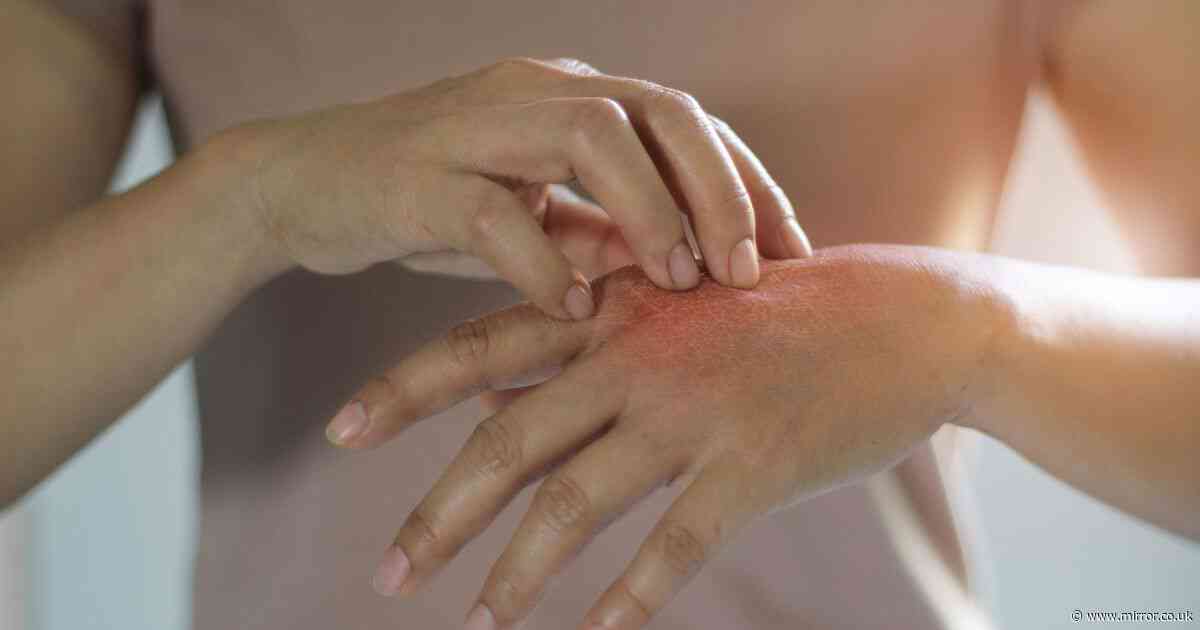 Eczema in children could be treated with vaccine 'within years' after major breakthrough