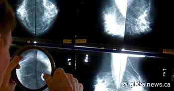 Begin breast cancer screening at age 40, Canadian Cancer Society urges